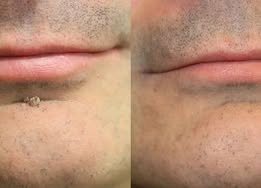 ✨KLENIMORE®2-in-1 Microneedle & Hydrocolloid Patch🍀| Removes Raised Moles, Acne, Flat Warts & Skin Tags | Helps Improve Wrinkles, Scars & Blemishes | Invisible Patches for Face & Body