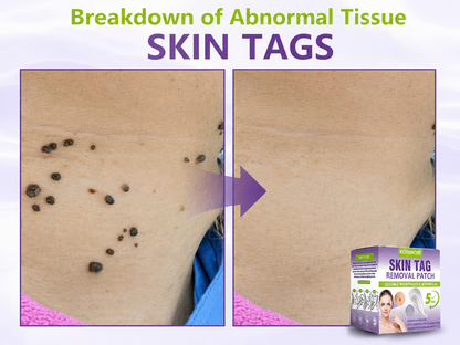 KLENIMORE® Soluble Microneedle Botanical Skin Tag Removal Patch