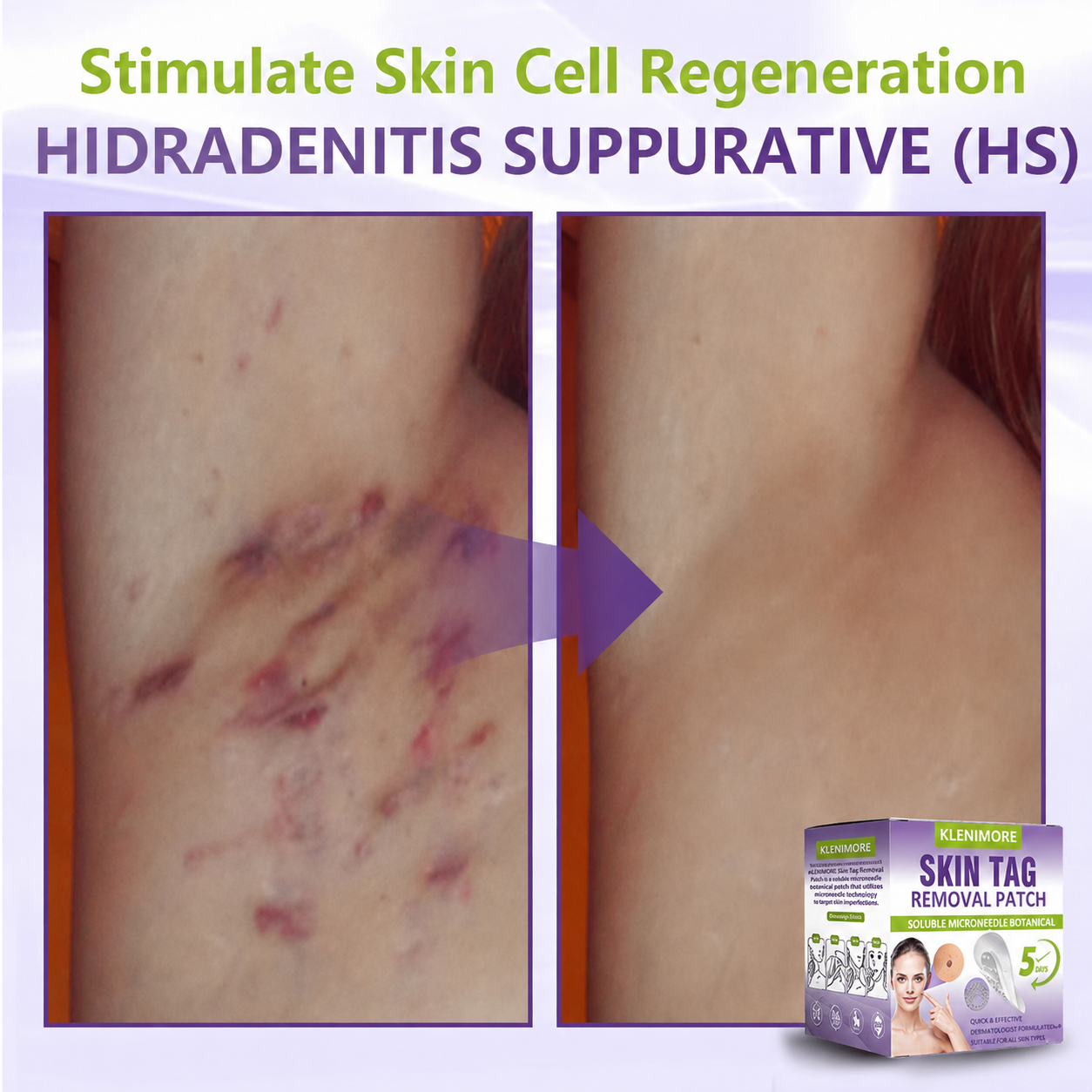 KLENIMORE® Soluble Microneedle Botanical Skin Tag Removal Patch