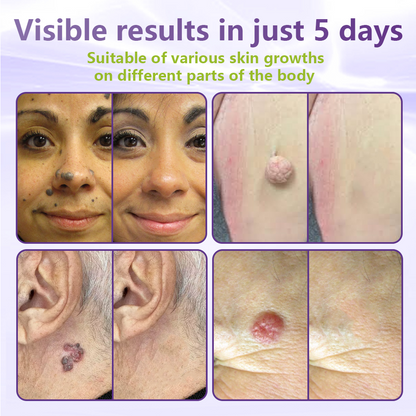 KLENIMORE® Soluble Microneedle Botanical Skin Tag Removal Patch
