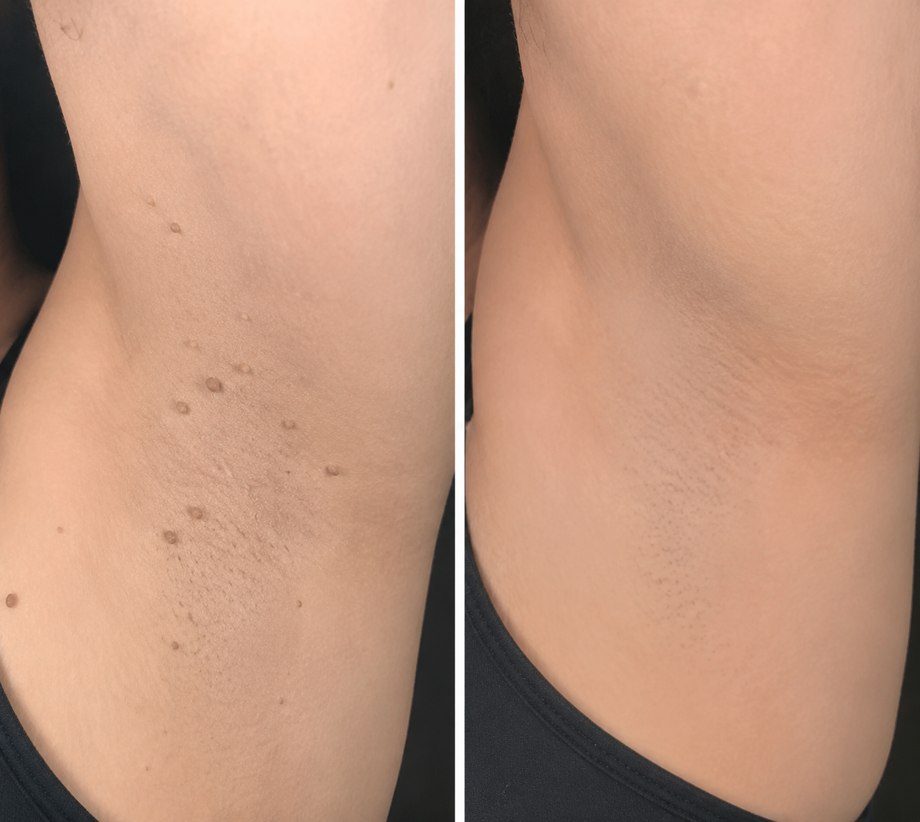 ✨KLENIMORE®2-in-1 Microneedle & Hydrocolloid Patch🍀| Removes Raised Moles, Acne, Flat Warts & Skin Tags | Helps Improve Wrinkles, Scars & Blemishes | Invisible Patches for Face & Body