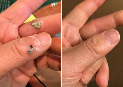 ✨KLENIMORE®2-in-1 Microneedle & Hydrocolloid Patch🍀| Removes Raised Moles, Acne, Flat Warts & Skin Tags | Helps Improve Wrinkles, Scars & Blemishes | Invisible Patches for Face & Body